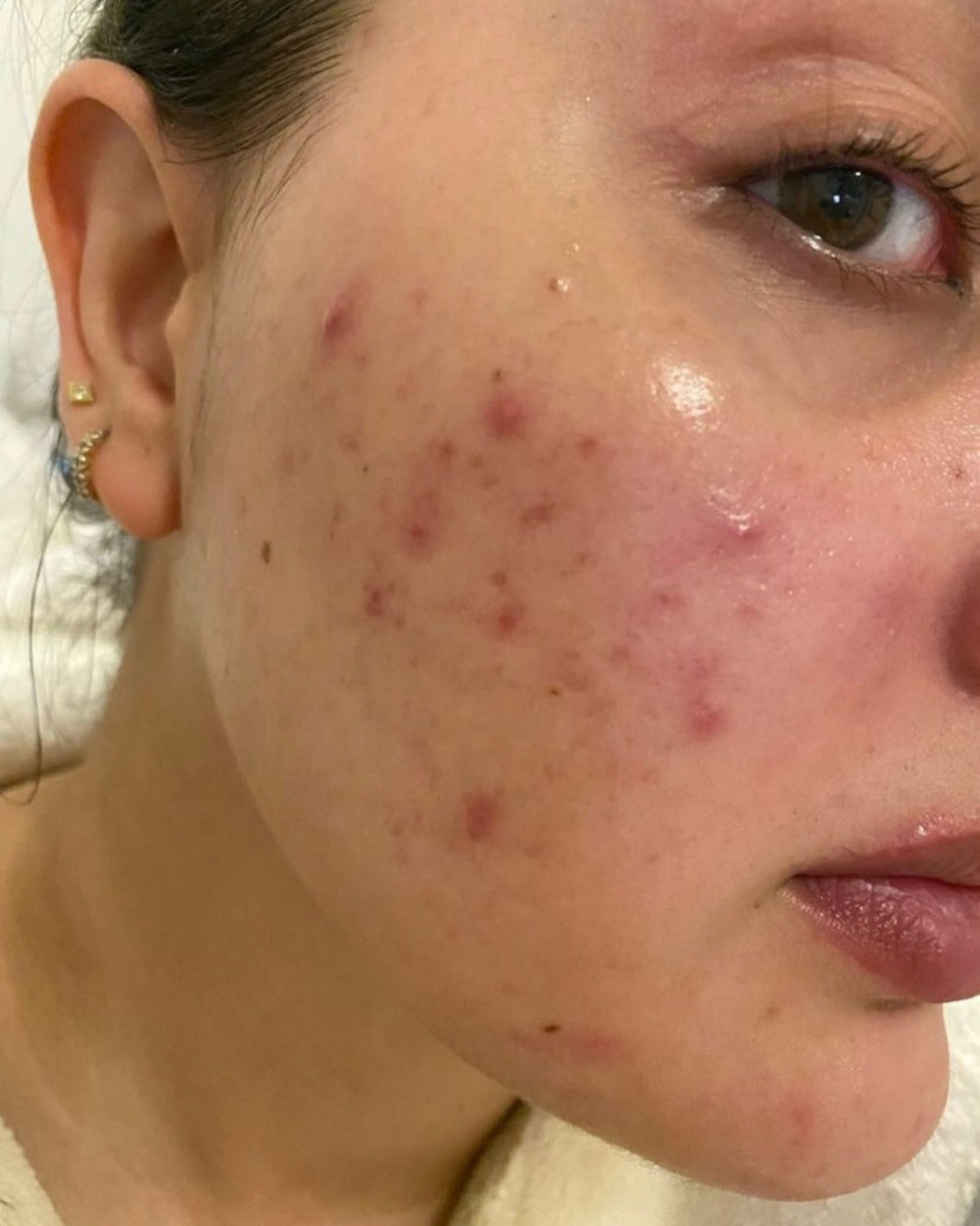 Close-up of a person's face with visible acne on the skin.