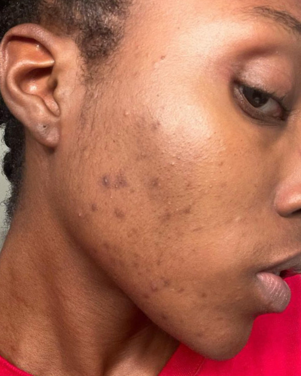Close-up of a person's face with visible acne on the cheek.